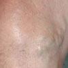 Varicose Veins