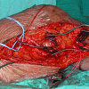 5cm politeal aneurysm with reverse vein graft