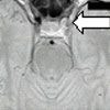 MRA scan showing reduced diameter of vessel (b)