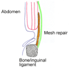 After mesh hernia repair