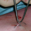 Vein Avulsion